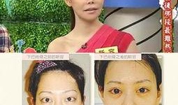 台湾节目爆料整容视频,揭秘明星整形真相